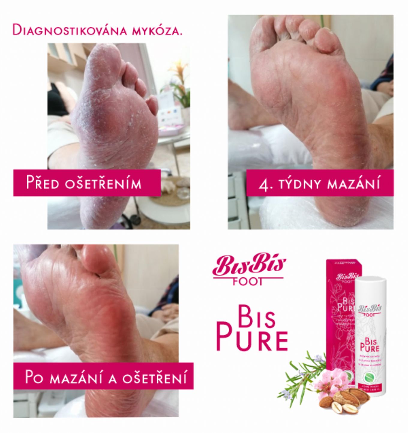 Mykoza Ruk Diagnóza mykóza | BisBis péče o nohy